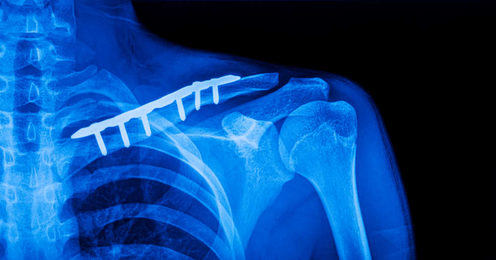 health insurance xray showing repaired clavicle.